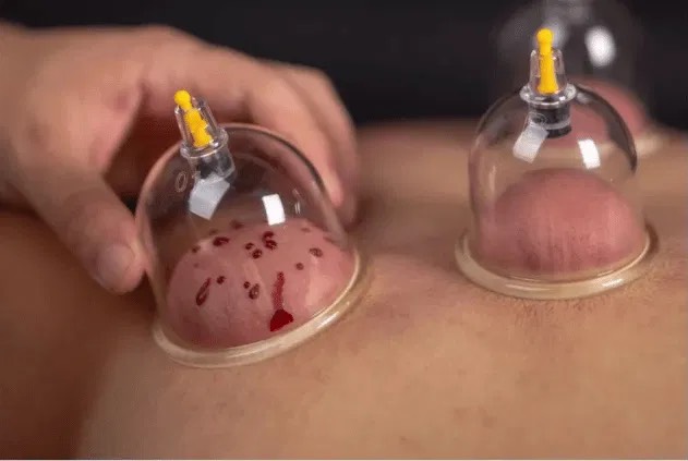 KỸ THUẬT CHÍCH LỂ & ỨNG DỤNG ĐIỀU TRỊ