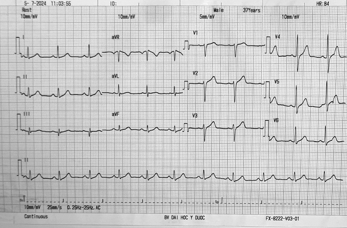 Bài tập phân tích ECG 1