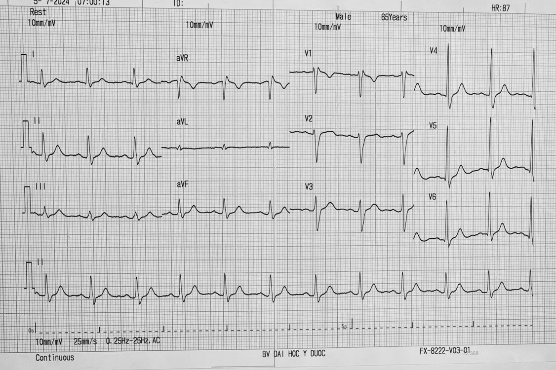 Bài tập phân tích ECG 2