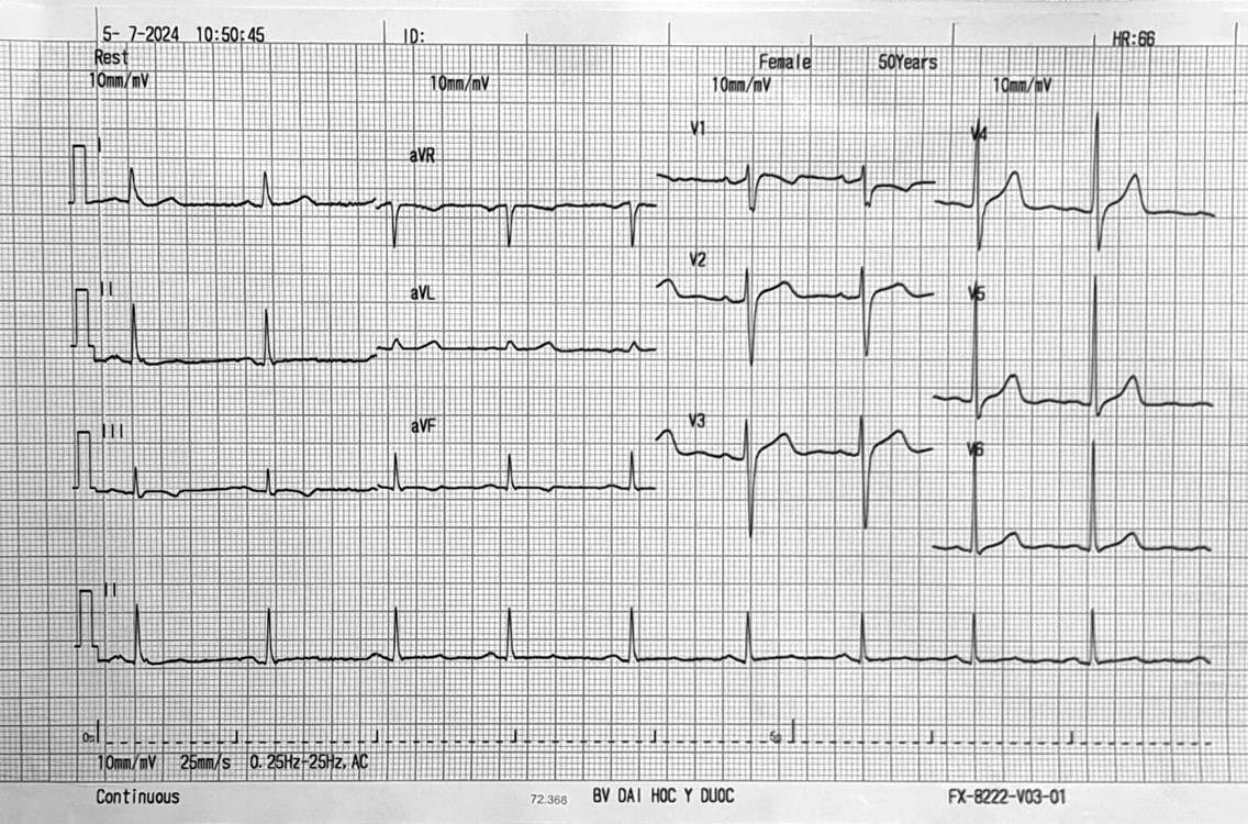 Bài tập phân tích ECG 3