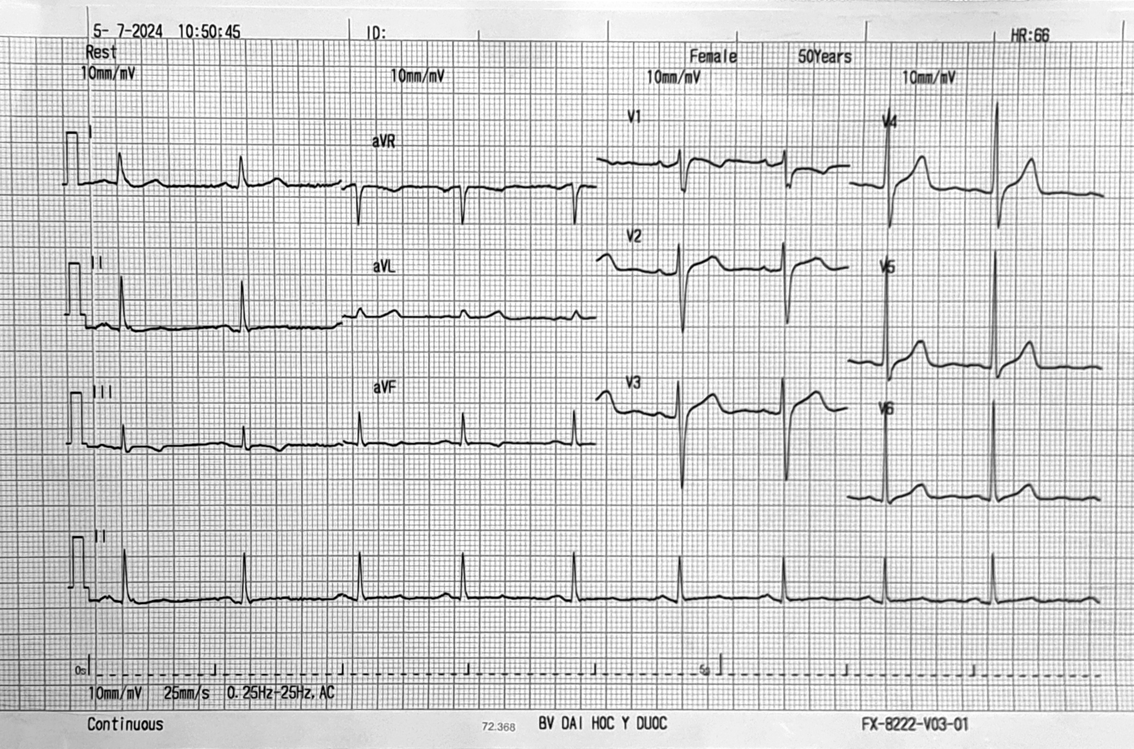 Bài tập phân tích ECG 4