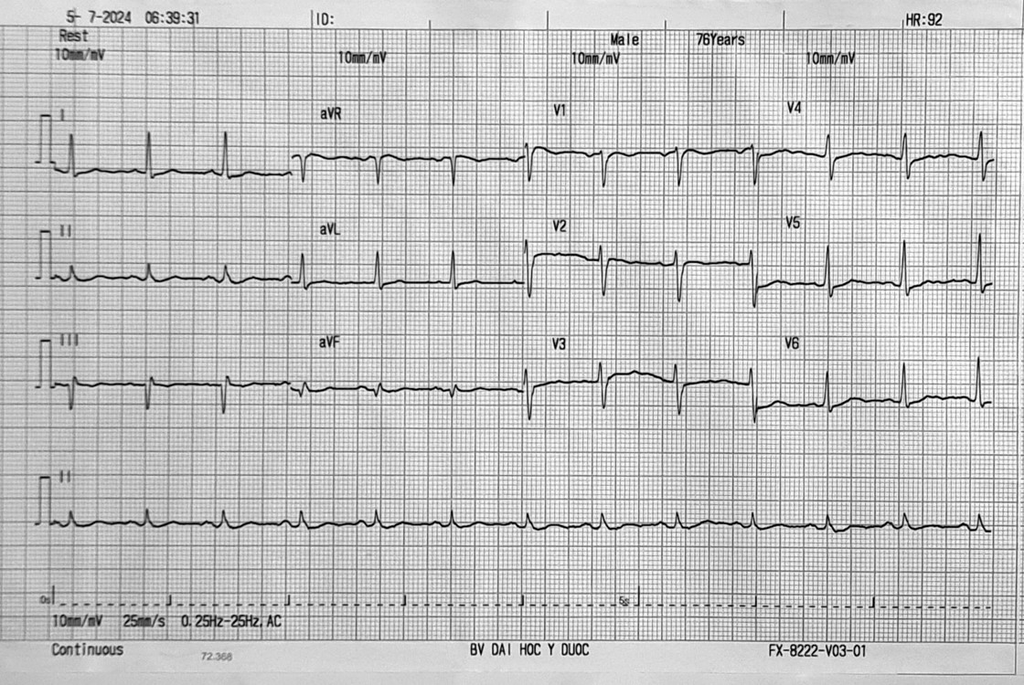 Bài tập phân tích ECG 5