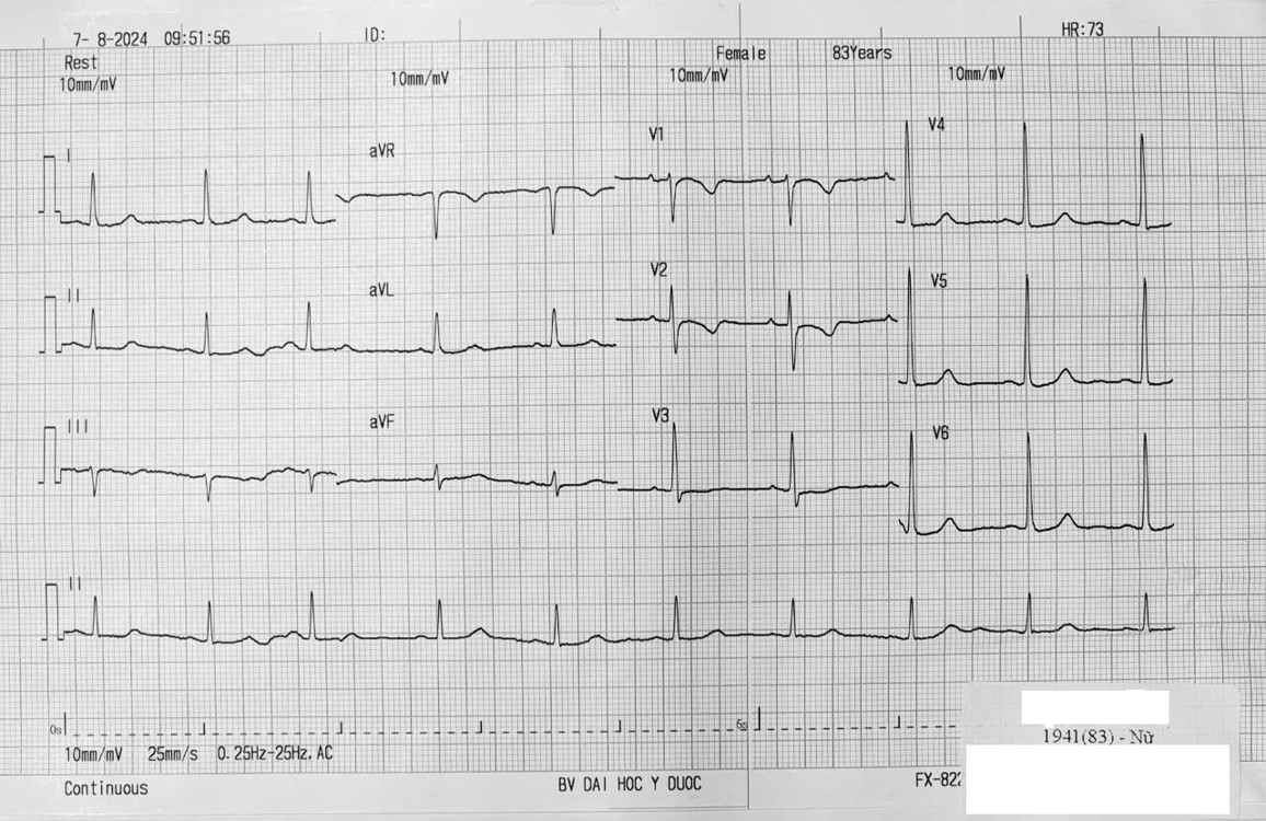 Bài tập phân tích ECG 6