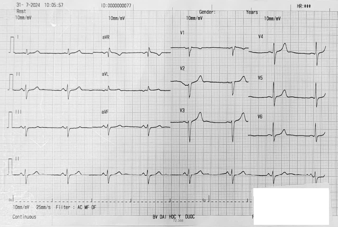 Bài tập phân tích ECG 7