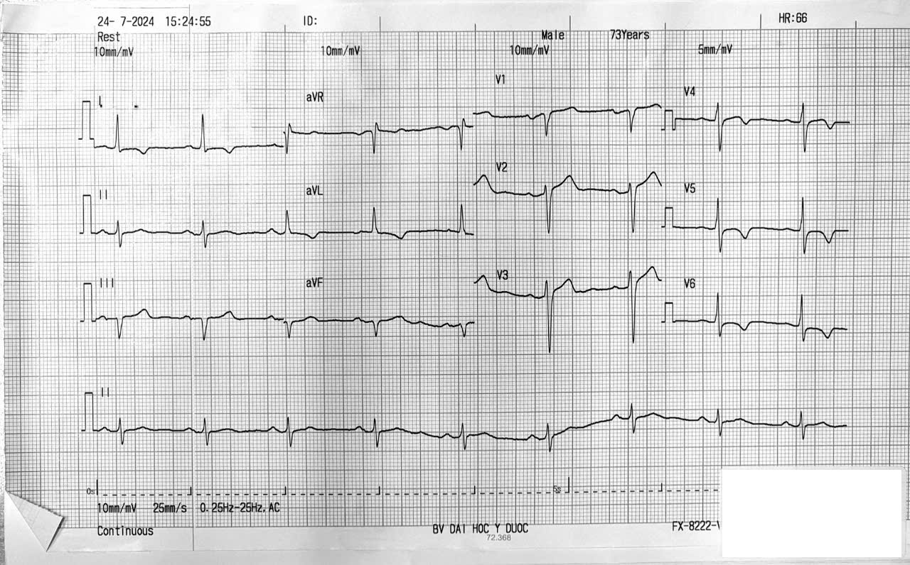 Bài tập phân tích ECG 8